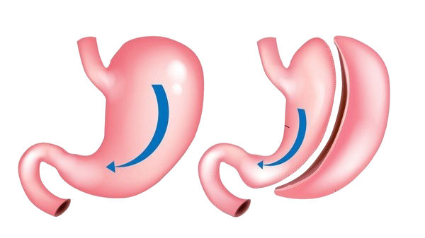 Gastric Sleeve Surgery
