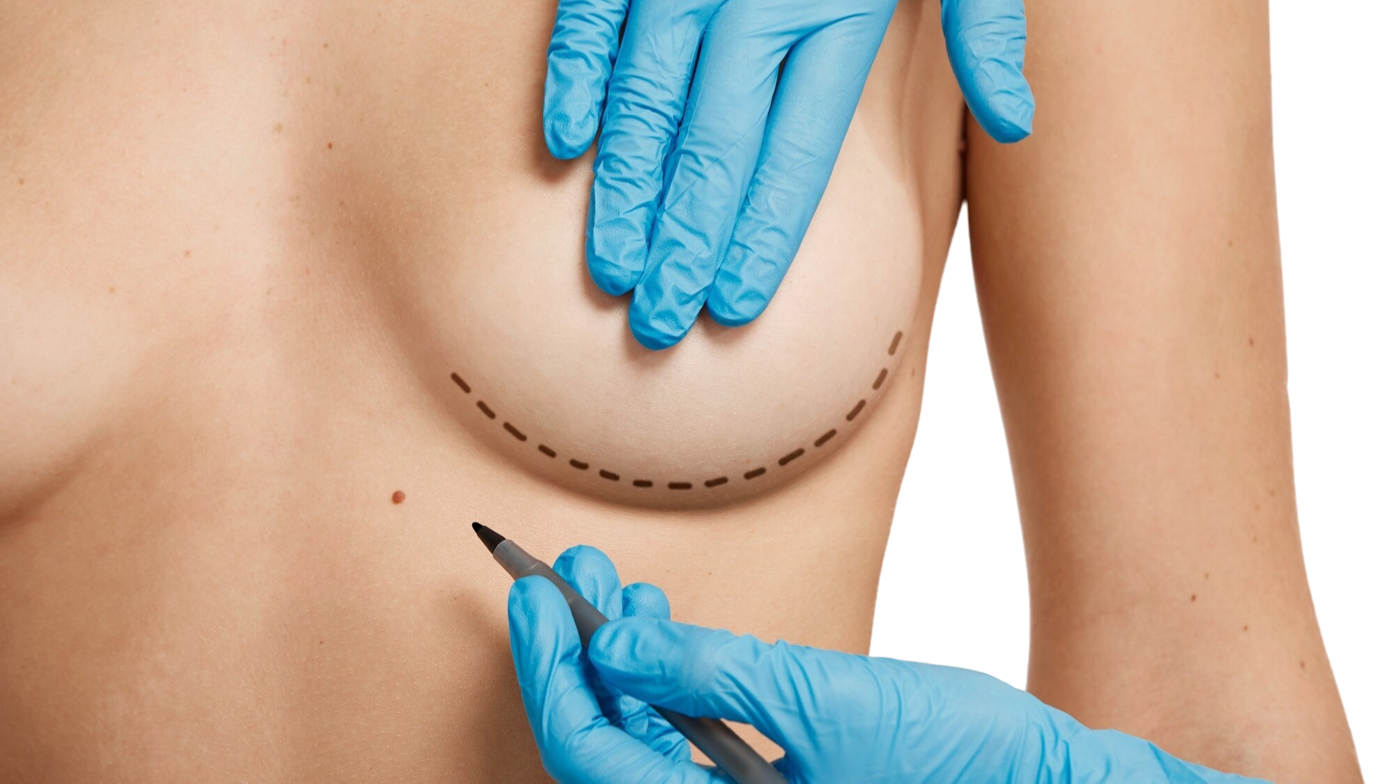 Breast Reconstruction