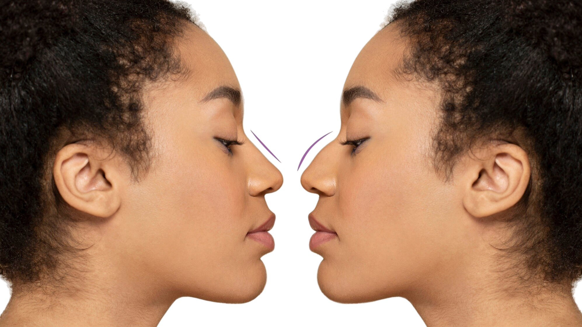 Rhinoplasty