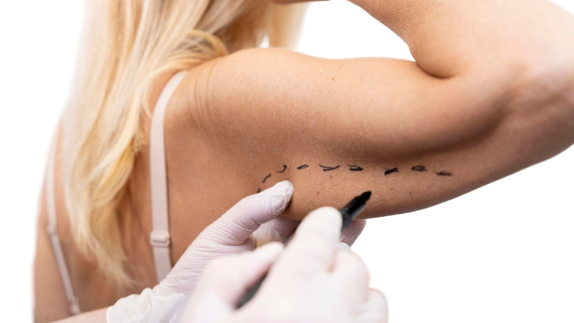 Arm Lift (Brachioplasty)